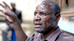 Maymun Çiçeği (mpox) virüsünün, hızla yayıldığı açıklanan yeni varyantı Afrika