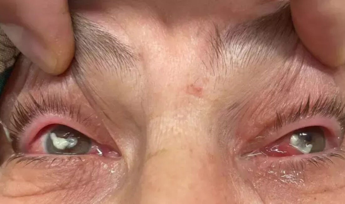 Kocaeli’de bir kadın, gözüne kırlangıç otu damlattı ve görme yetisini