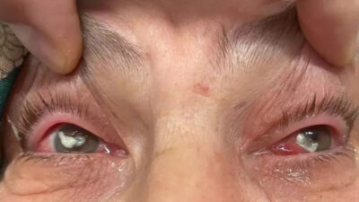 Kocaeli’de bir kadın, gözüne kırlangıç otu damlattı ve görme yetisini