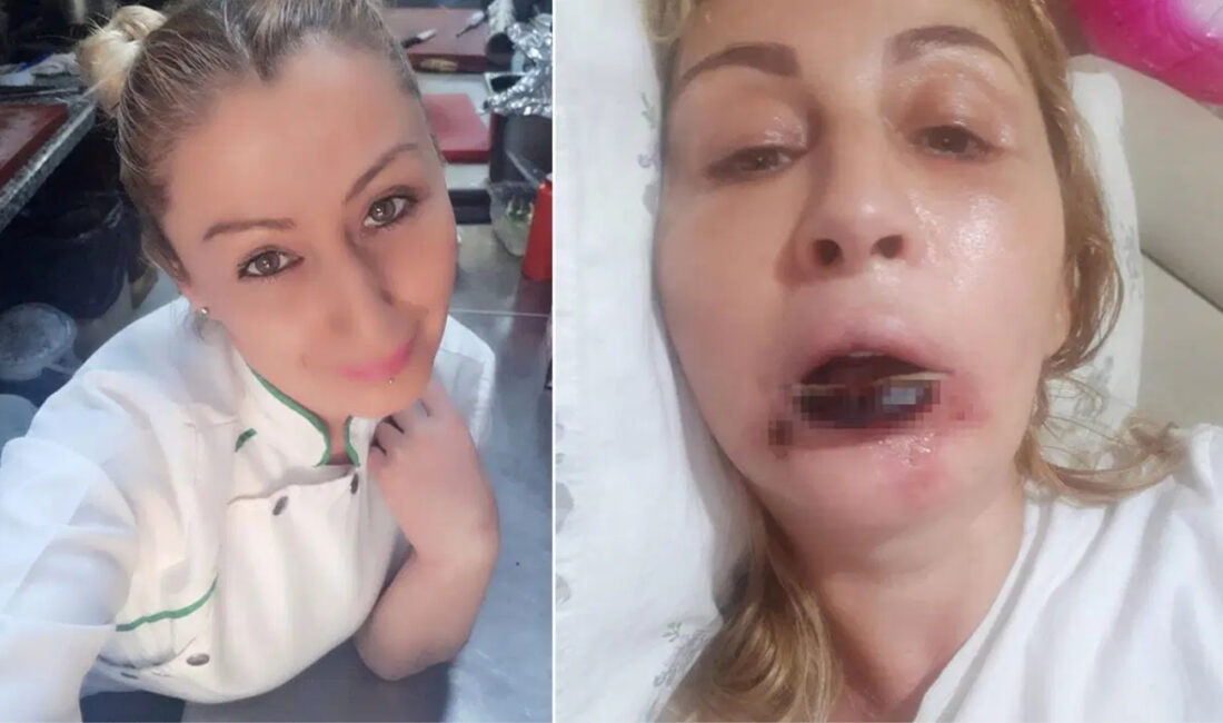 Antalya’da estetik işlem yaptırdıktan sonra dudağında doku kaybı yaşadığını öne