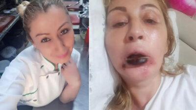 Antalya’da estetik işlem yaptırdıktan sonra dudağında doku kaybı yaşadığını öne